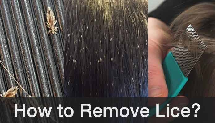 How to Get Rid of Lice Fast & Naturally