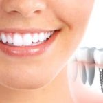 Dental-Implants-–-Is-This-A-Safe-Option-To-Go-For