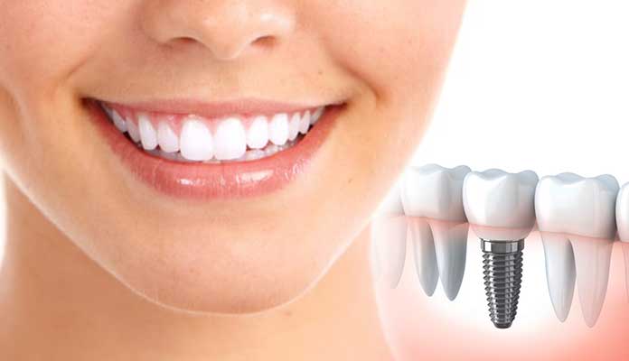 Dental Implants – Is It a Safe Option to Choose