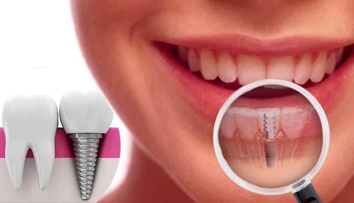 Dental Implants – Is It a Safe Option to Choose