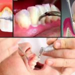 Teeth-Scaling-and-Root-Planing