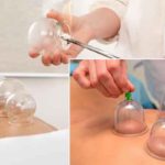 Benefits-of-cupping-(hijama)-therapy