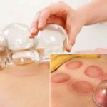 Benefits-of-cupping-(hijama)-therapy-massage