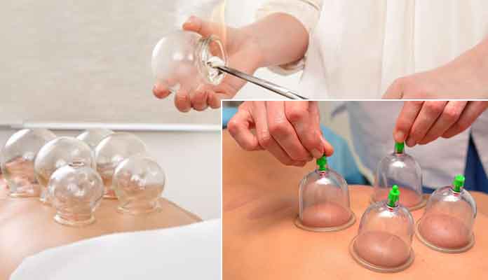 Benefits of Cupping Therapy Massage