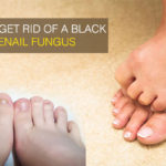 How-to-get-rid-of-a-black-toenail-fungus