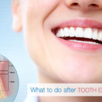What-to-do-after-tooth-extraction