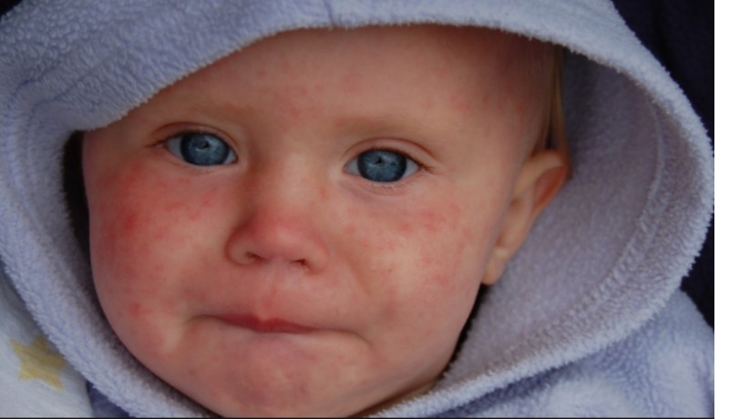 Measles Outbreak in United States